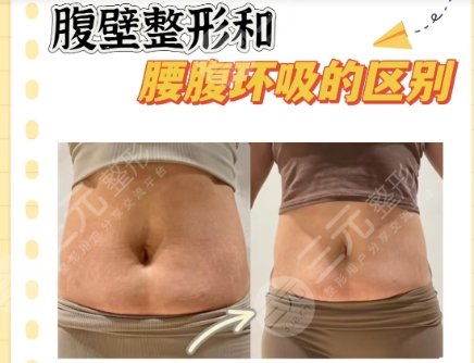 吸脂