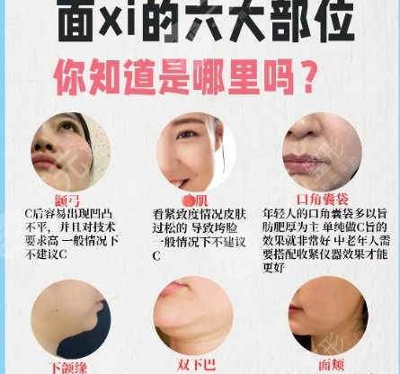 面部吸脂