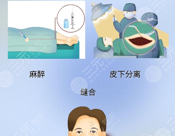 拉皮