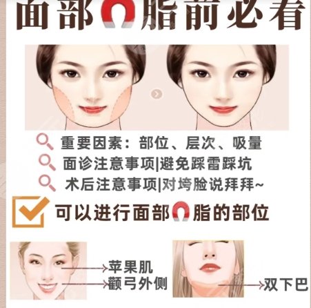 面部吸脂