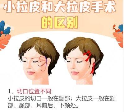 拉皮