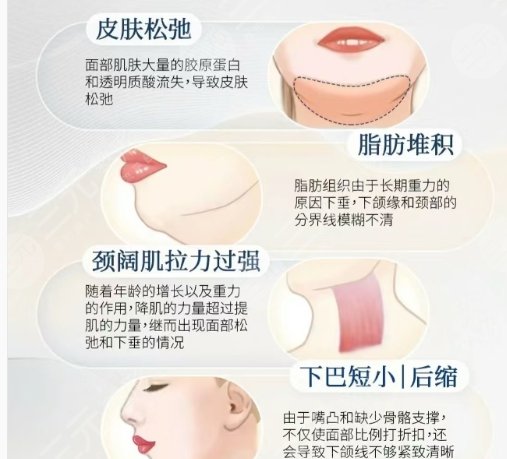 下颌角