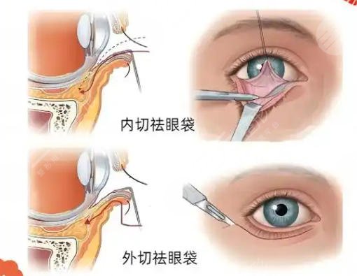 去眼袋