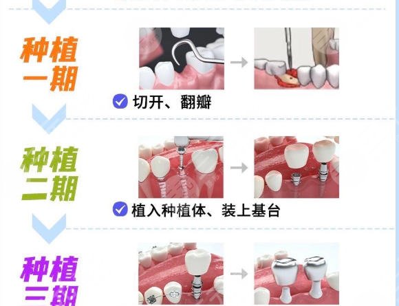 牙齿种植