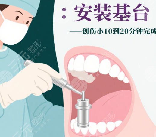 牙齿种植