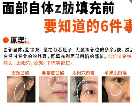 面部填充