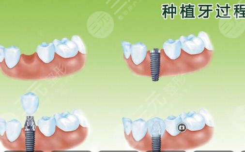 牙齿种植
