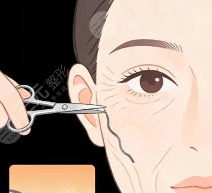 筋膜提升