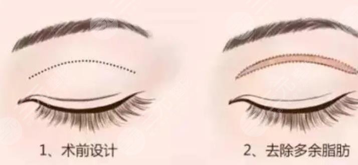 双眼皮