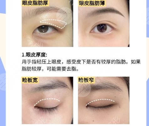双眼皮