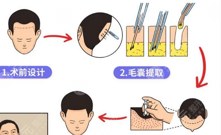 植发