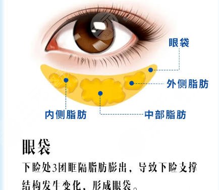 去眼袋