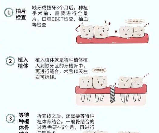 牙齿种植