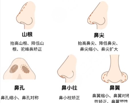 隆鼻
