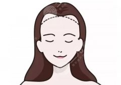 齐鲁二院植发价格表！告别“发际线焦虑”，这份攻略请收好！