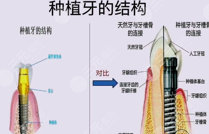 牙齿种植