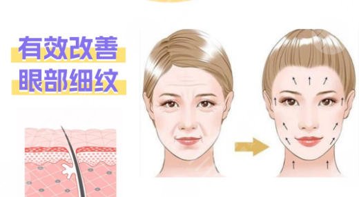 除皱