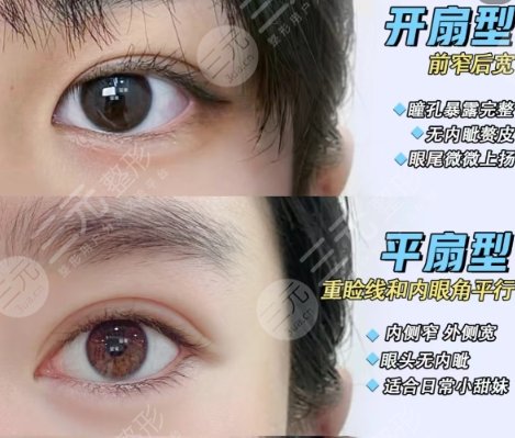 双眼皮