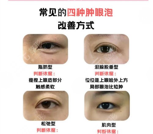 双眼皮修复