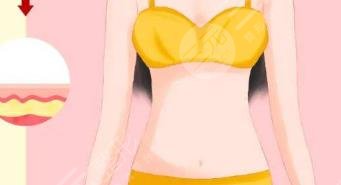 腹壁整形