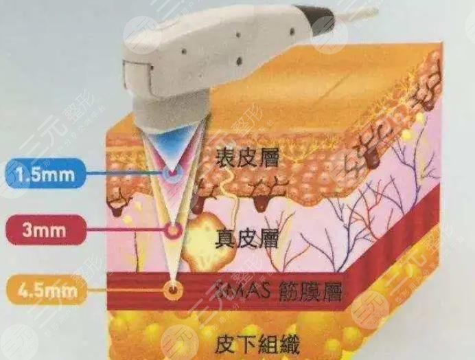 除皱