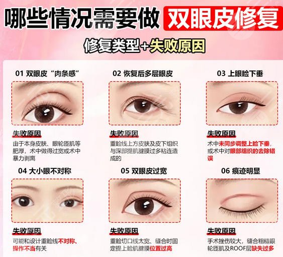 双眼皮
