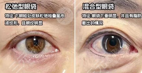 去眼袋