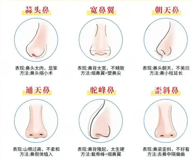 隆鼻