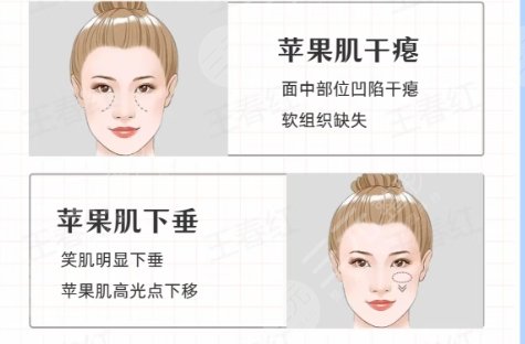 苹果肌