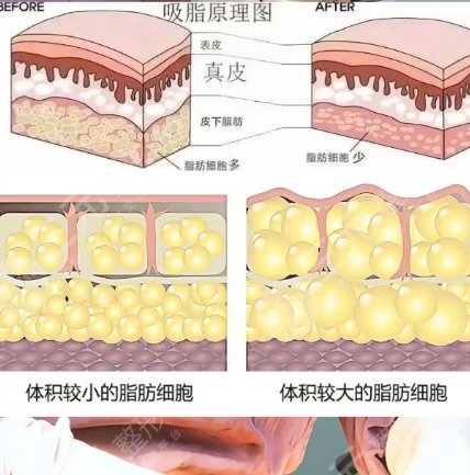 吸脂