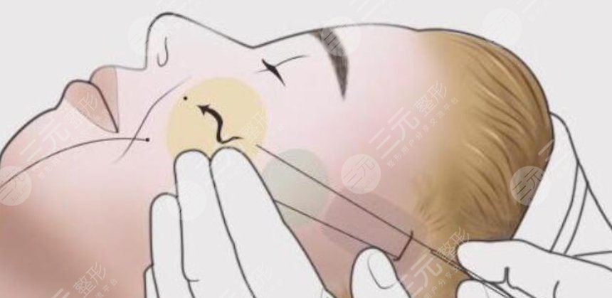 除皱