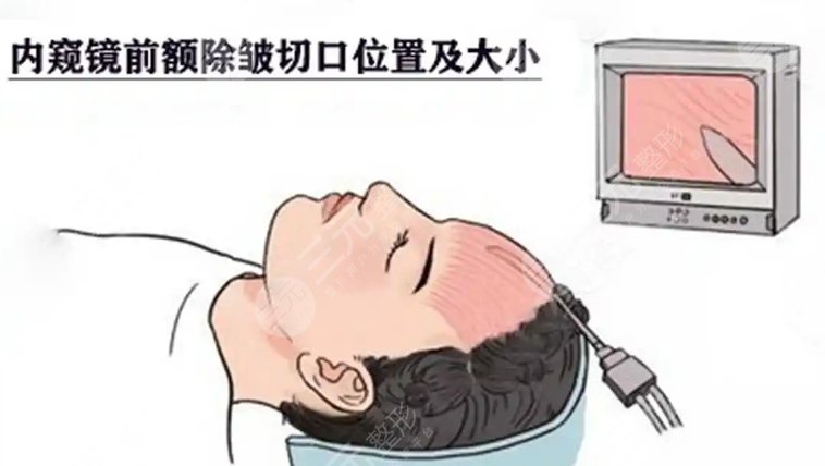 除皱