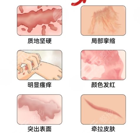 祛疤
