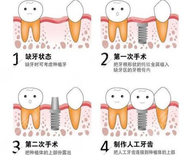 牙齿种植