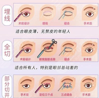 双眼皮