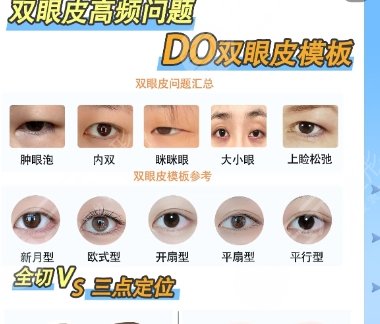 双眼皮