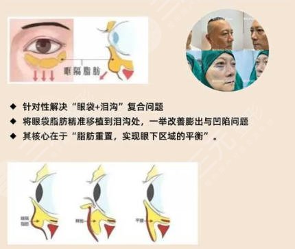 去眼袋