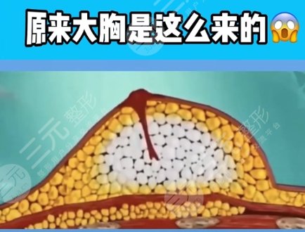 隆胸