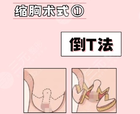 缩胸