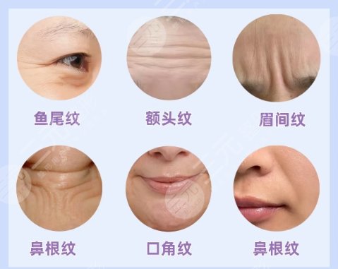 除皱