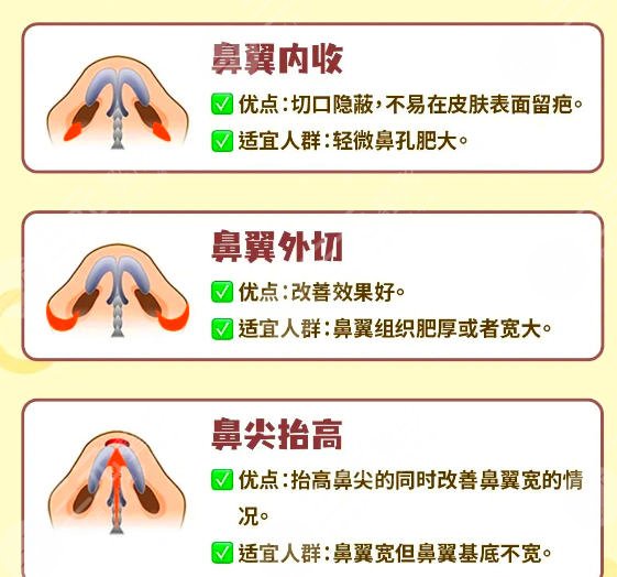 鼻翼缩小