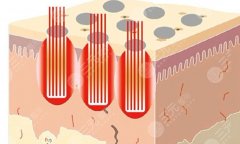 大连医科大学附属第一医院点阵激光仪器怎么样？设备类型、适合问题和收费参考
