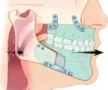 南昌(江西)省人民医院正颌手术费用为什么差距大？检查、方案和住院费用都要算