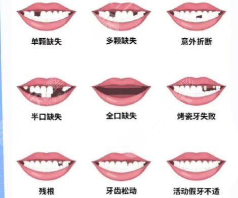 牙齿种植