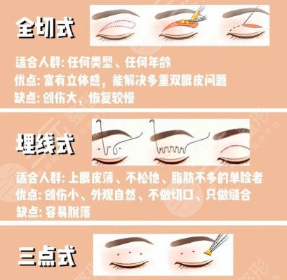 双眼皮