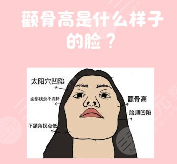 颧骨整形