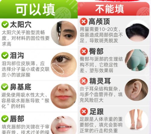 面部填充