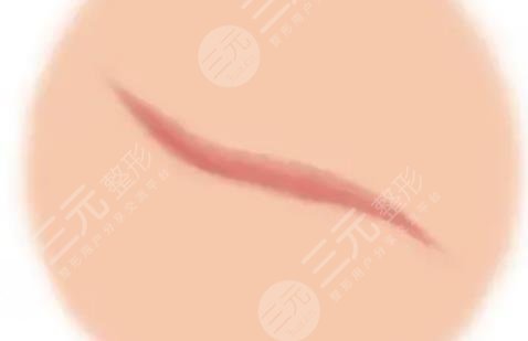 疤痕