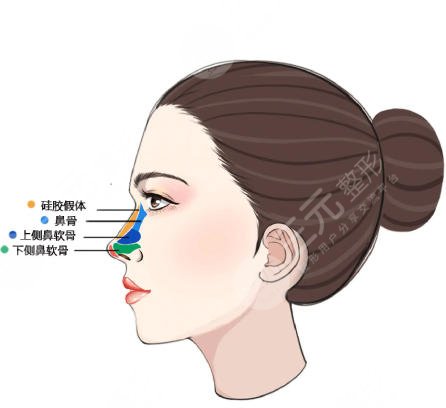 隆鼻