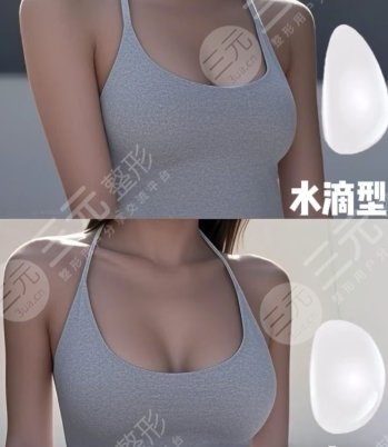 隆胸